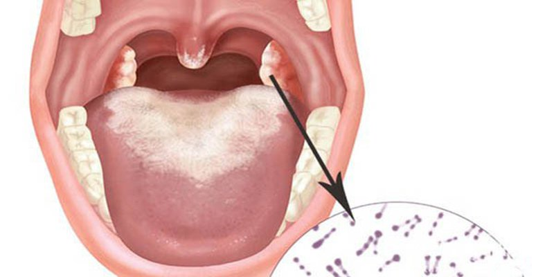 Bạch hầu - Bệnh mới nổi, thách thức của hệ thống y tế Việt Nam