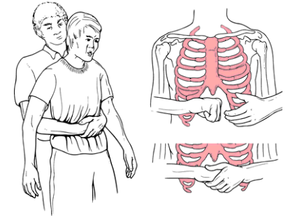 CÁCH THỰC HIỆN BIỆN PHÁP HEIMLICH