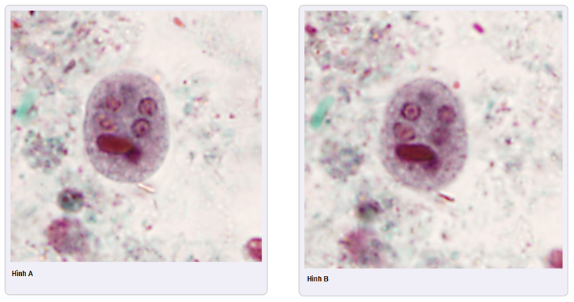 Ca nhiễm ký sinh trùng do Amip (Entamoeba histolytica/ Entamoeba dispar)