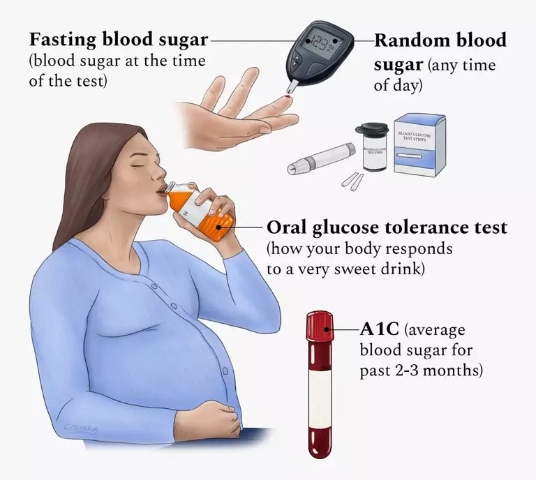 PHƯƠNG PHÁP XÉT NGHIỆM VÀ CHẨN ĐOÁN  ĐÁI THÁO ĐƯỜNG TRONG THAI KỲ