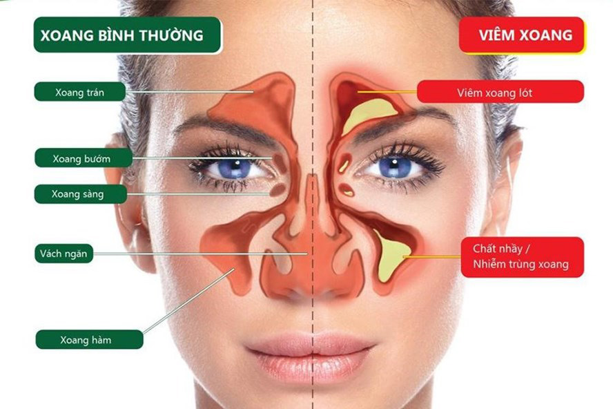 Hướng dẫn Châu Âu về Bệnh lý Viêm mũi xoang theo y học chứng cứ