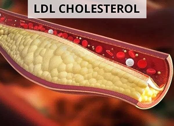 NHỮNG PHƯƠNG PHÁP LÀM GIẢM LDL CHOLESTEROL MÁU