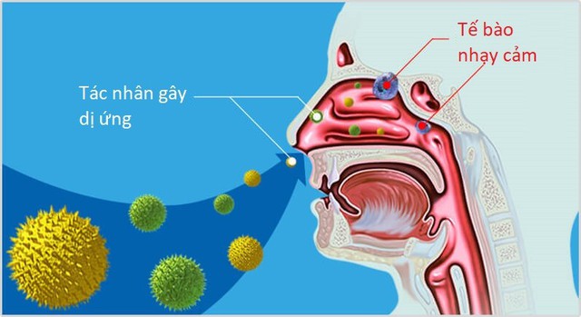 BẬC THANG TRONG ĐIỀU TRỊ VIÊM MŨI DỊ ỨNG