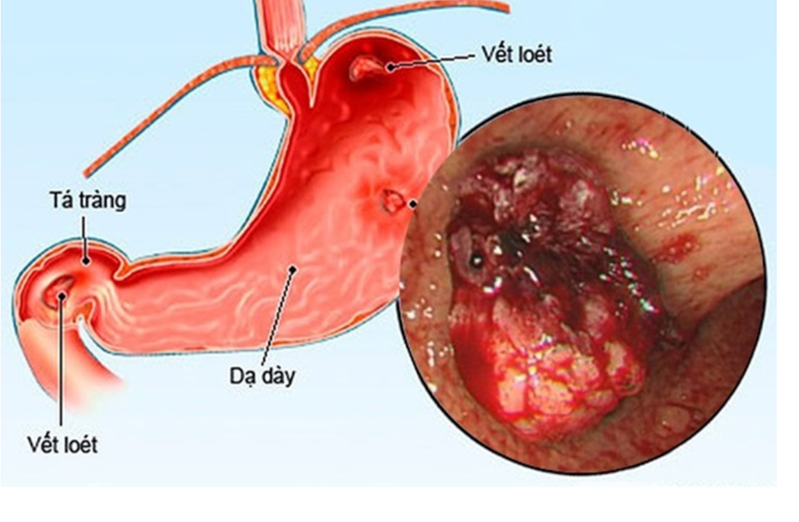 Vết loét dạ dày