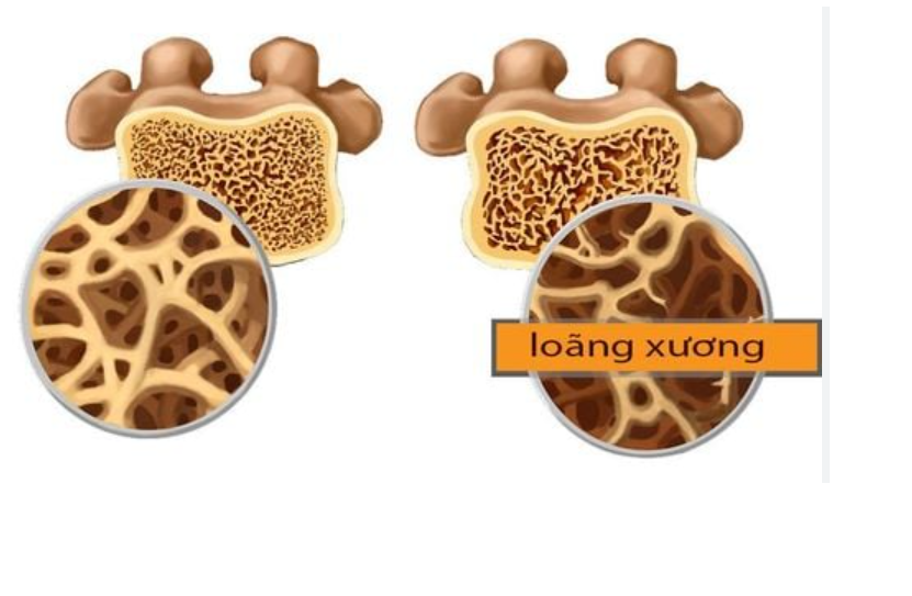 Khối lượng riêng của xương
