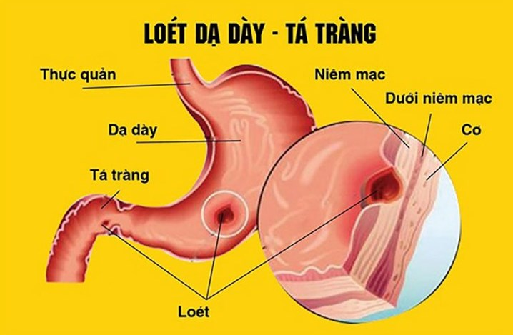 Loét dạ dạy